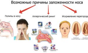 Заложенность носа или сухой насморк