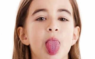 Скарлатина: основные симптомы и лечение у детей