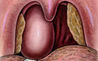 Причины и лечение абсцесса горла