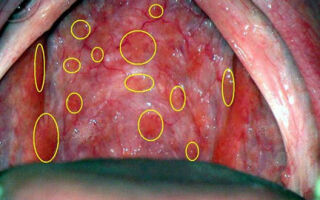 Причины появления волдырей на задней стенке горла