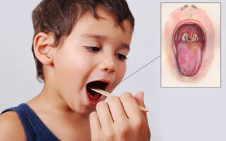 Причины появления белого налета на миндалинах у детей