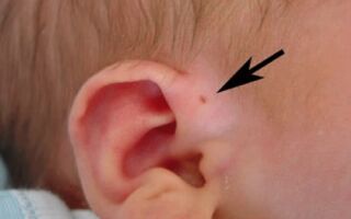 Свищ в области уха: особенности его протекания