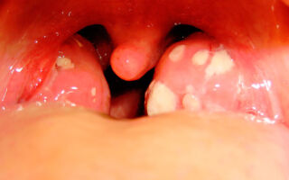 Причины и лечение гнойников в горле