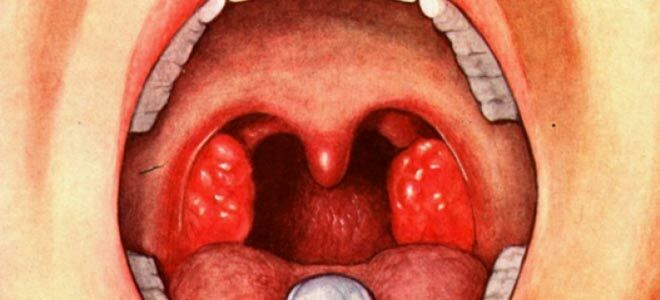 Почему возникают белые точки в горле и как от них избавиться?